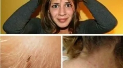 Ochrana před vši: jak se chránit